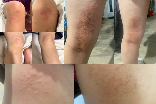Eczema Relief That Actually Works: My Story & Customers’ Stories